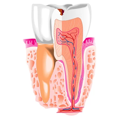 зубная накладка керамическая пломба