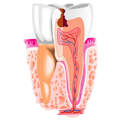 керамическая пломба накладка на зубы