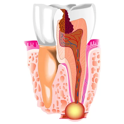 коронка на зубы