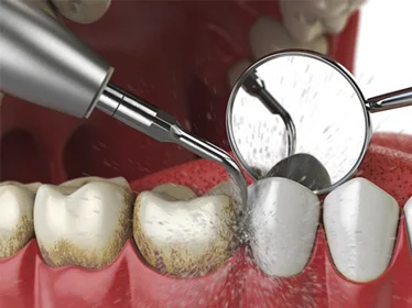 Ультразвуковая чистка зубов