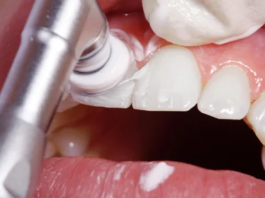 Полировка зубов