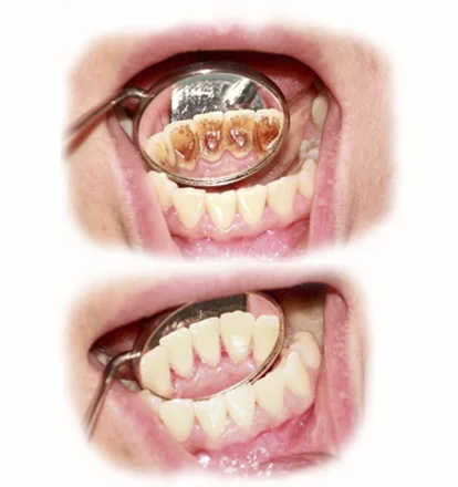 эстетическая реставрация передних зубов на позняках ахматовой григоренко урловская