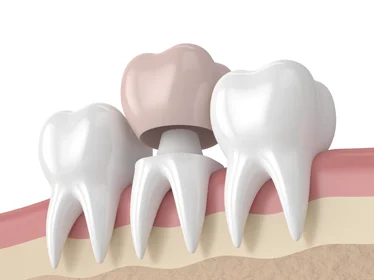 зубная коронка