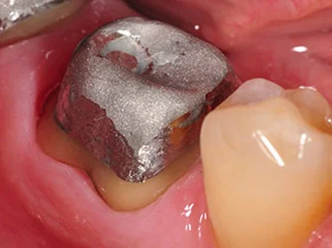 культя зуба пенёк вкладка металлическая