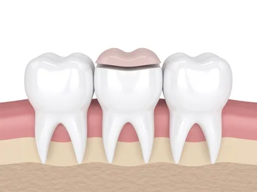 керамическая накладка на зуб (onlay)