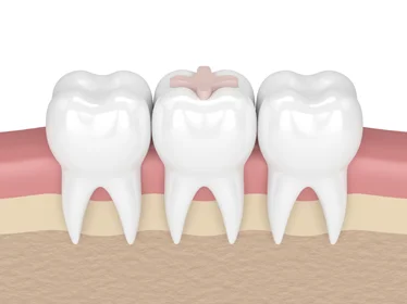 керамическая вкладка на зуб (inlay)