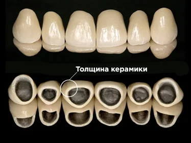 коронка металлокерамика