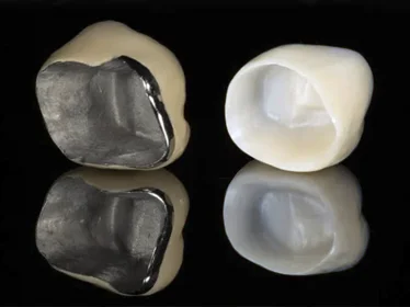 циркониевая и металлокерамическая коронка