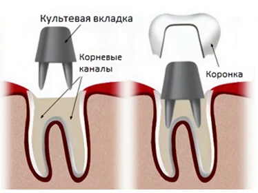 культевая вкладка зуба