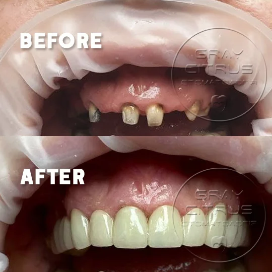 пример работы — коронки на зубы