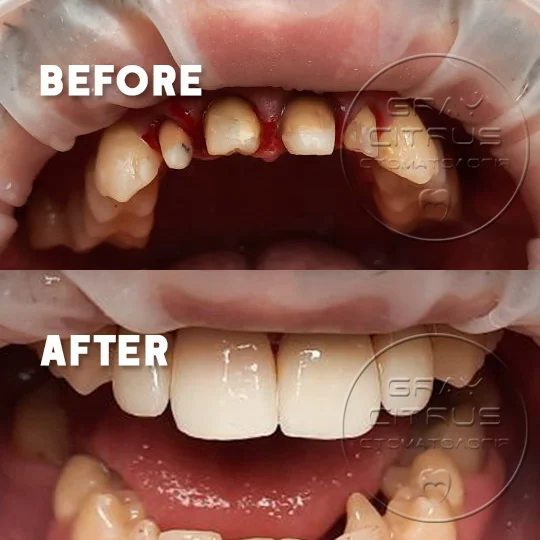 пример работы — протезирование коронками