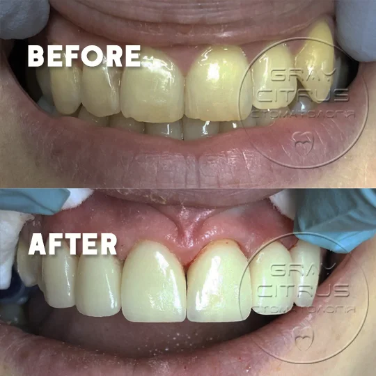 пример работы — циркониевая коронка