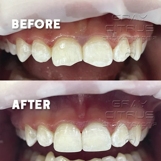 фотополимерная реставрация зубов цена Киев Позняки