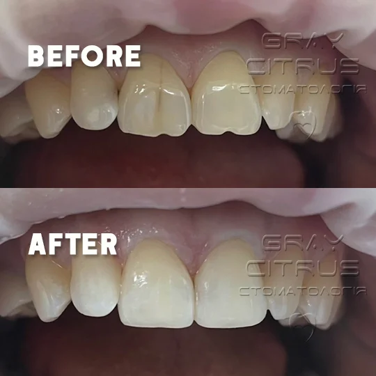 композитная реставрация зубов Киев Позняки