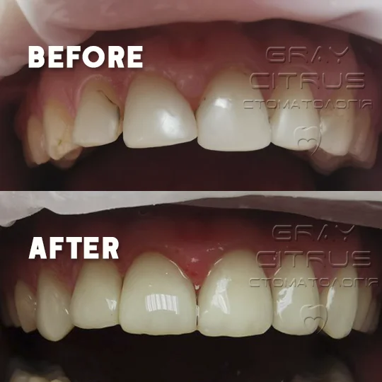 реставрация передних фронтальных зубов на Позняках