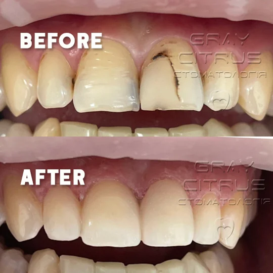 наращивание передних фронтальных зубов в Киеве