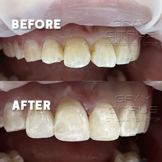 наращивание и реставрация передних зубов в Киеве