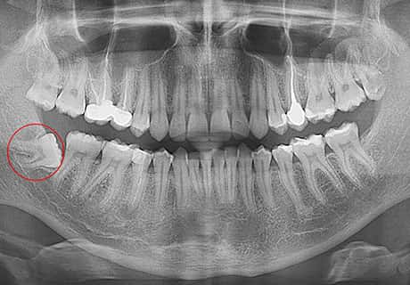 неправильно расположенный зуб мудрости атипичное удаление