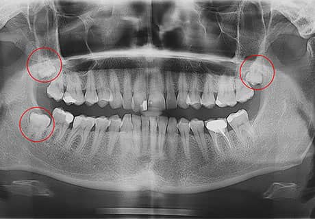 ретинированный зуб мудрости удаление не вырос полностью